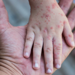 Virus Coxsackie